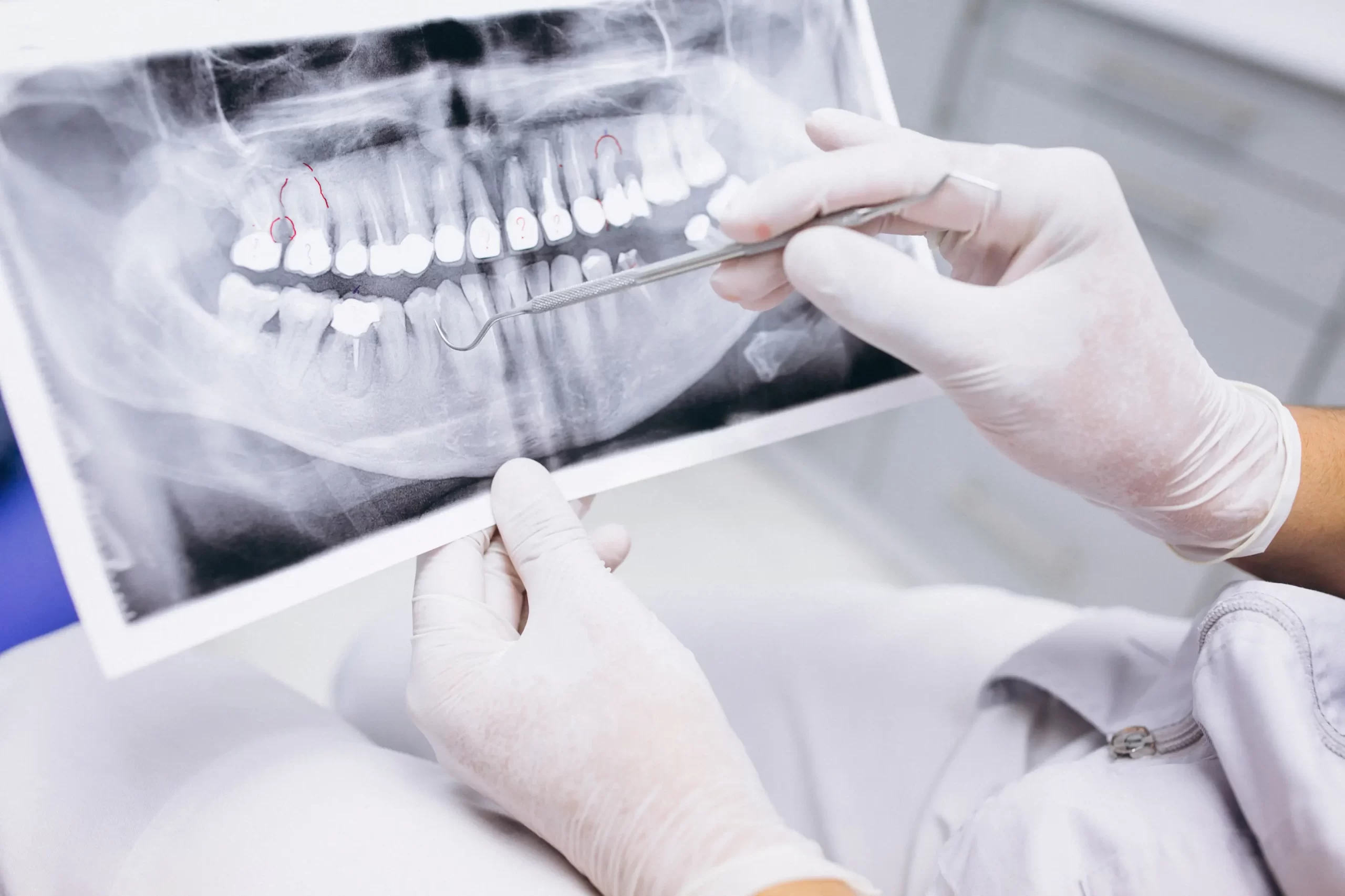 dentista concepcion. señales de que necesitas un tratamiento de endodoncia